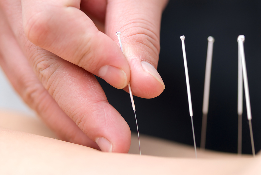 Fine acupuncture needles placed during treatment